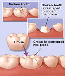 Dental Crowns Cedar Rapids, IA