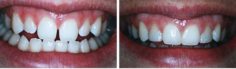  Tooth Bonding Example 2 Cedar Rapids, IA
